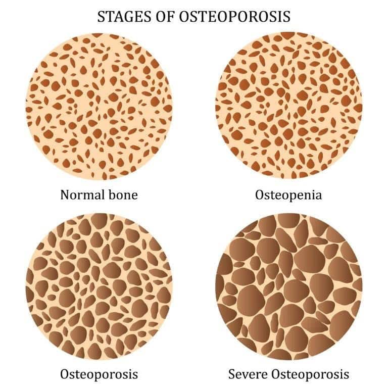 What Does It Mean If I Have Low Bone Density 